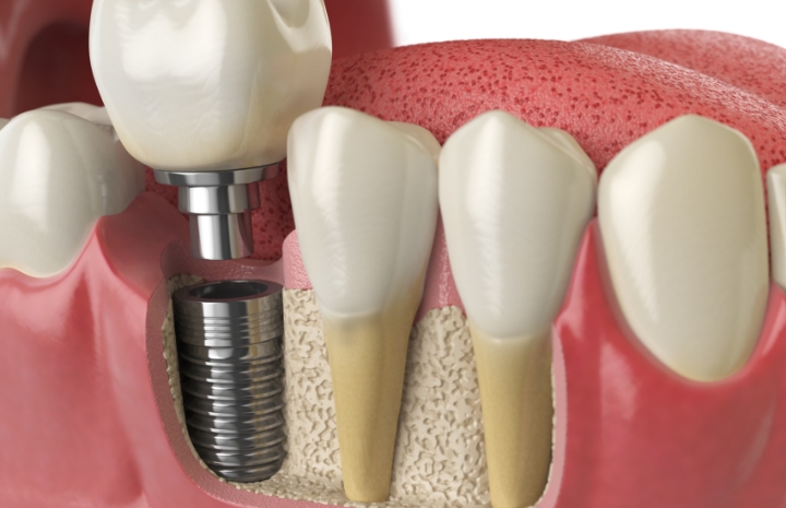 Animated smile showing the dental implant tooth replacement process