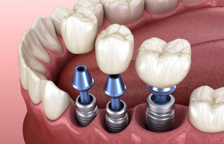 Animated smile showing three teeth being replaced by dental implants
