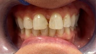 Closeup of smile with damaged front teeth