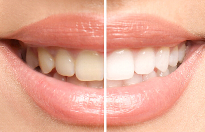 before and after of teeth whitening