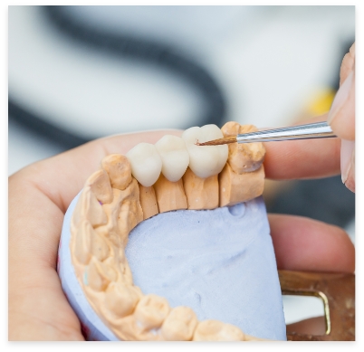 Model smile with a traditional dental bridge