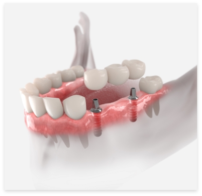 Animated smile during dental implant supported fixed bridge placement