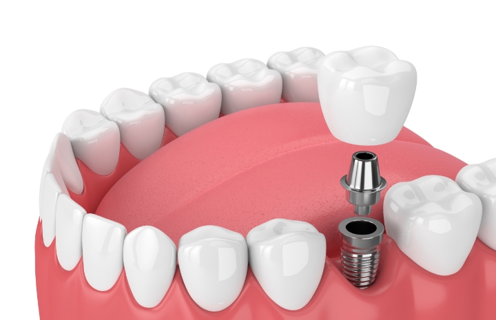 Animated smile during dental implant placement