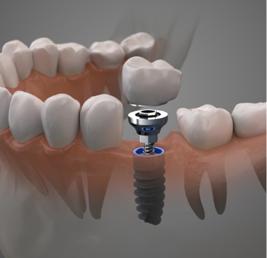 Animated smile showing dental implant restoration placement
