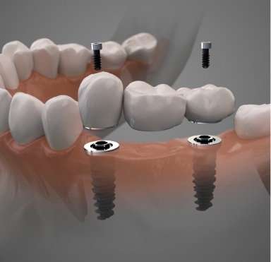 Animated smile during dental implant supported fixed bridge placement