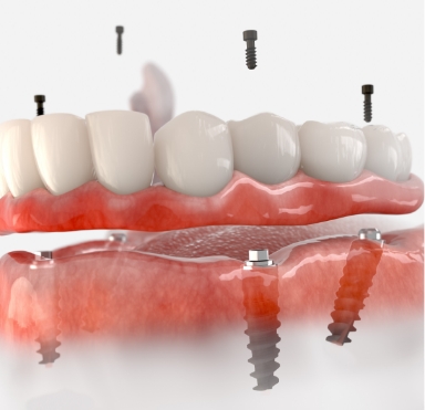 Animated smile during dental implant supported denture placement