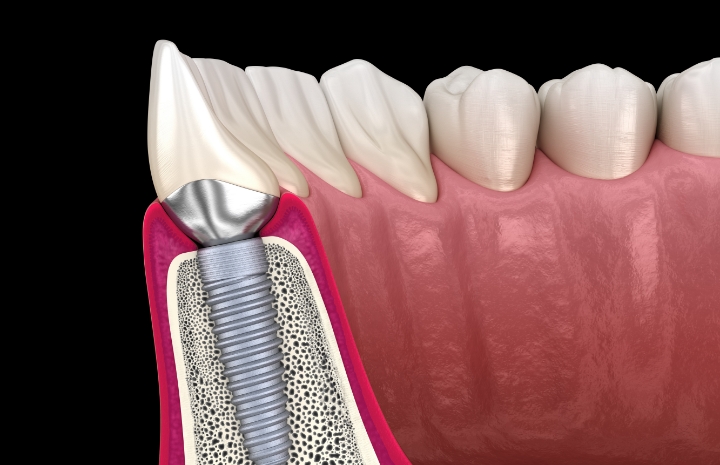Animated smile showing what dental implants look like in the gum line