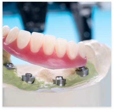 Model dental implant retained dentures