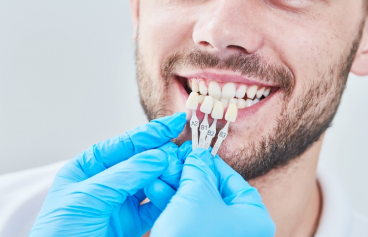 Man's smile compared with veneers shade chart