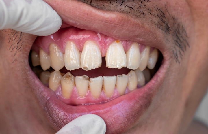 Closeup of smile with dental damage before cosmetic dentistry