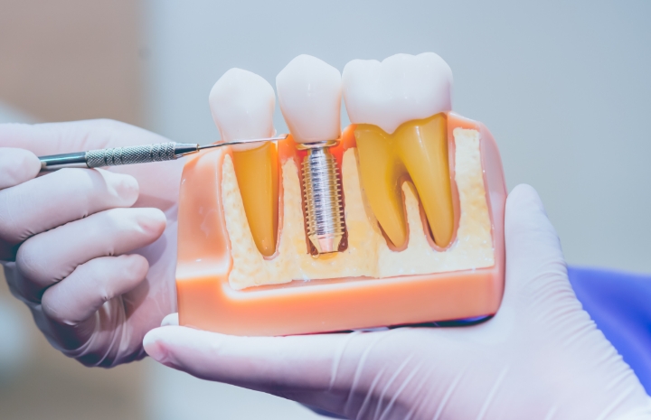 Dentist using model smile to explain how dental implant salvage works