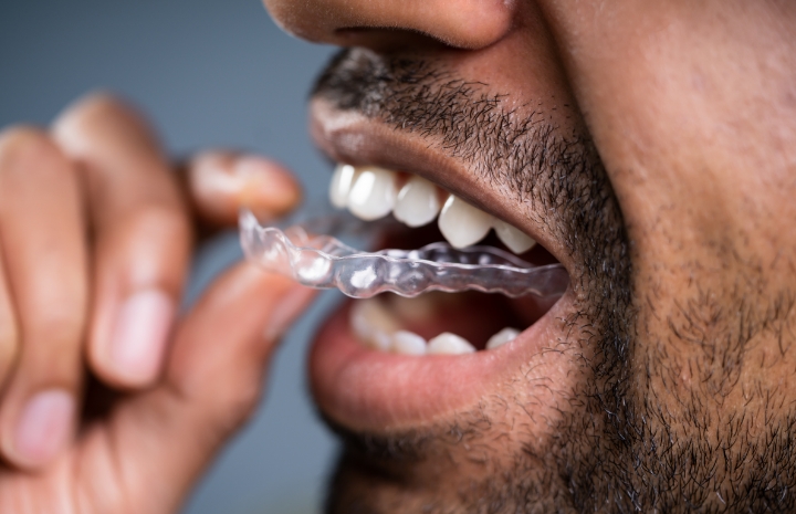 Closeup of dental patient placing an Invisalign tray