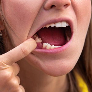 Woman pulling back her lip to reveal missing tooth