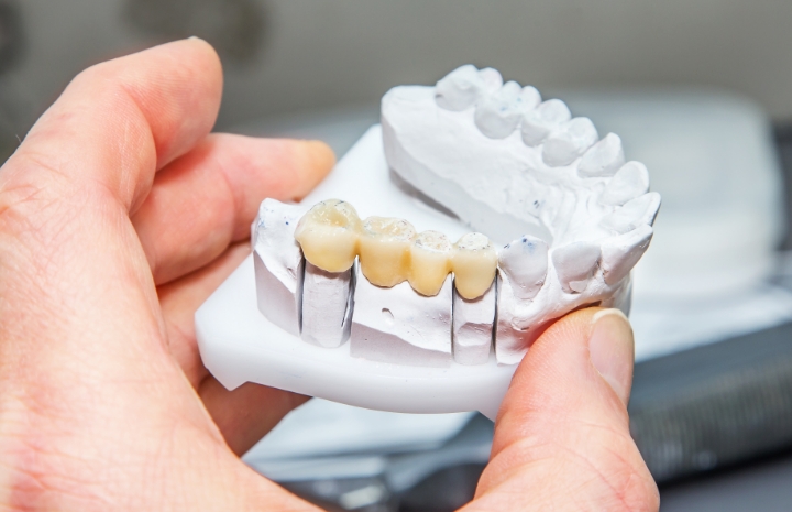 Model smile with dental bridge restoration