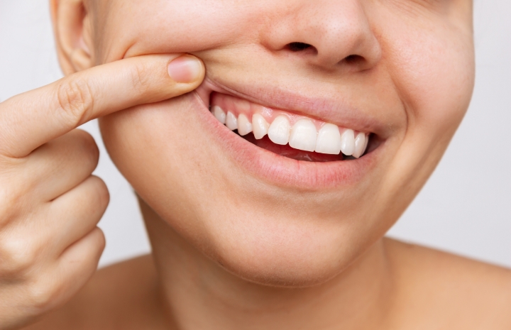 Closeup of smile after gum disease treatment