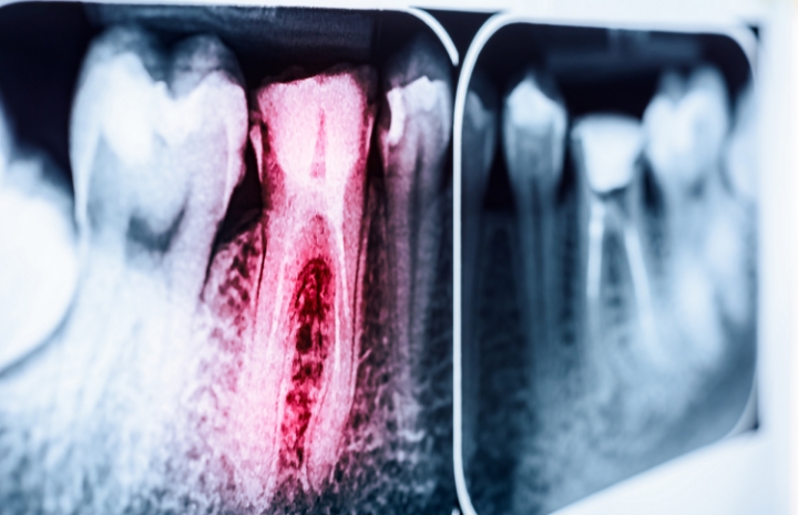 X ray of tooth after root canal treatment