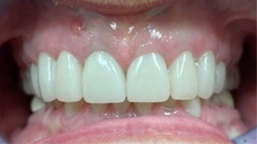 Healthy bright smile after dental treatment