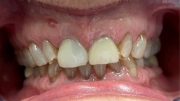 Damaged and discolored teeth before dental treatment