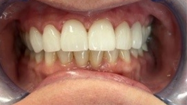 Closeup of smile after damaged front teeth are repaired