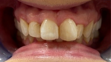 Closeup of discolored smile