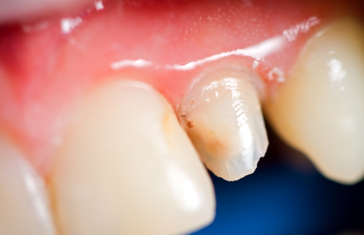 Closeup of damaged smile before tooth colored fillings