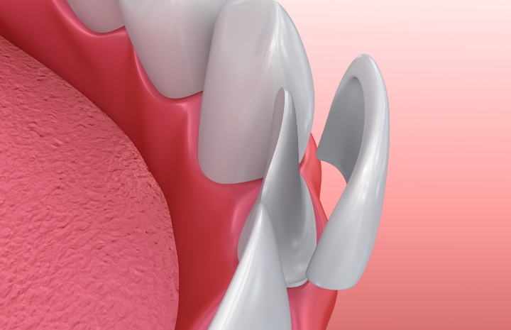 Animated smile during veneer placement