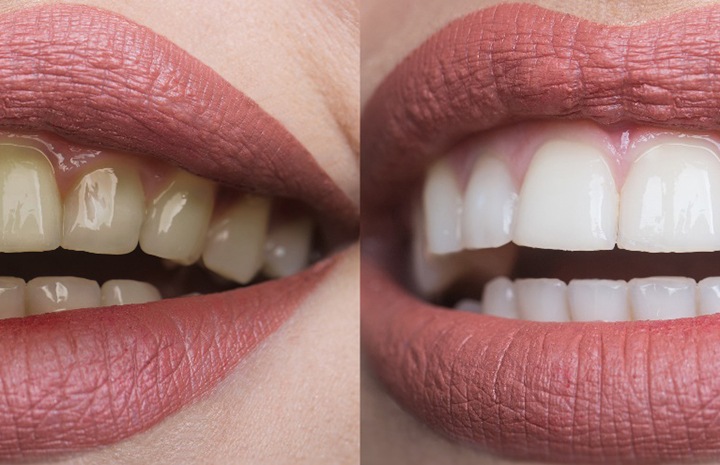 Before and after image of teeth whitening