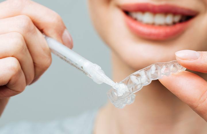 At-home teeth whitening