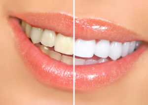 woman smiling before after teeth whitening