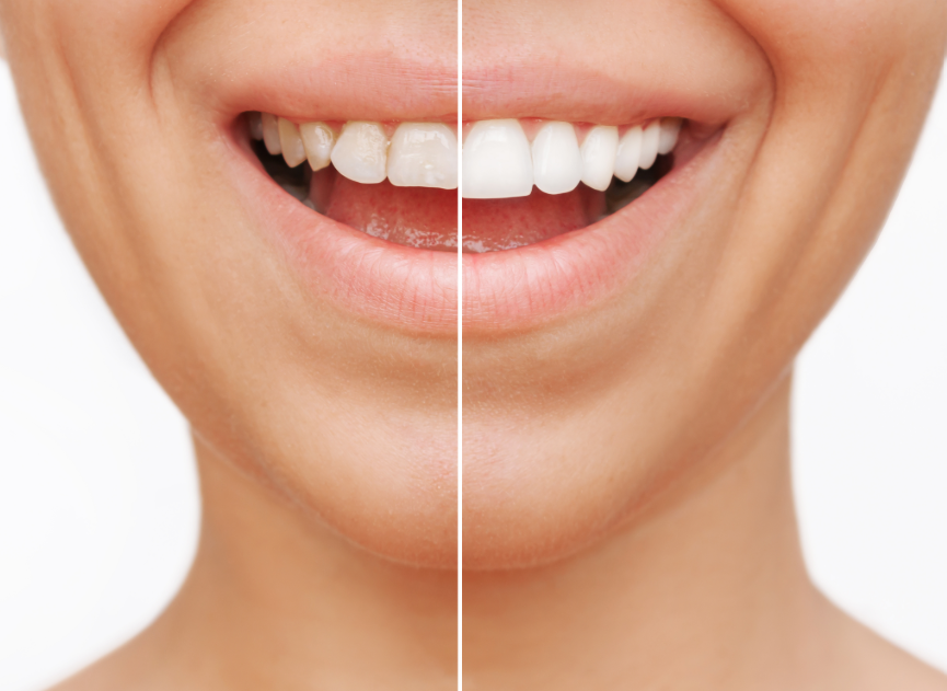 Woman's smile half veneers, half natural teeth
